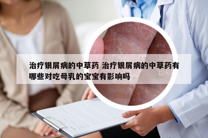 治疗银屑病的中草药 治疗银屑病的中草药有哪些对吃母乳的宝宝有影响吗