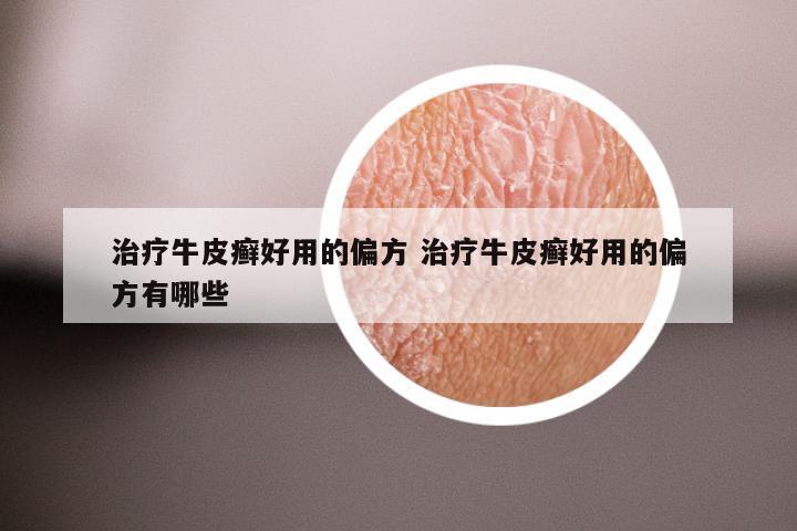 治疗牛皮癣好用的偏方 治疗牛皮癣好用的偏方有哪些