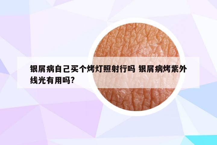 银屑病自己买个烤灯照射行吗 银屑病烤紫外线光有用吗?