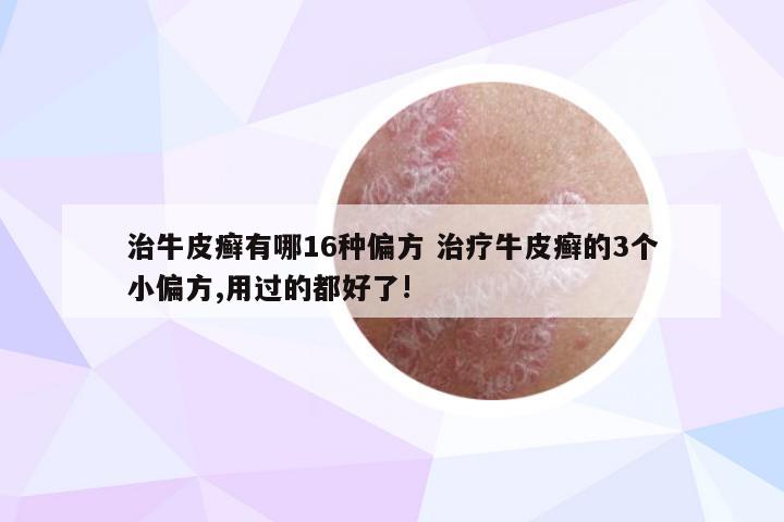 治牛皮癣有哪16种偏方 治疗牛皮癣的3个小偏方,用过的都好了!