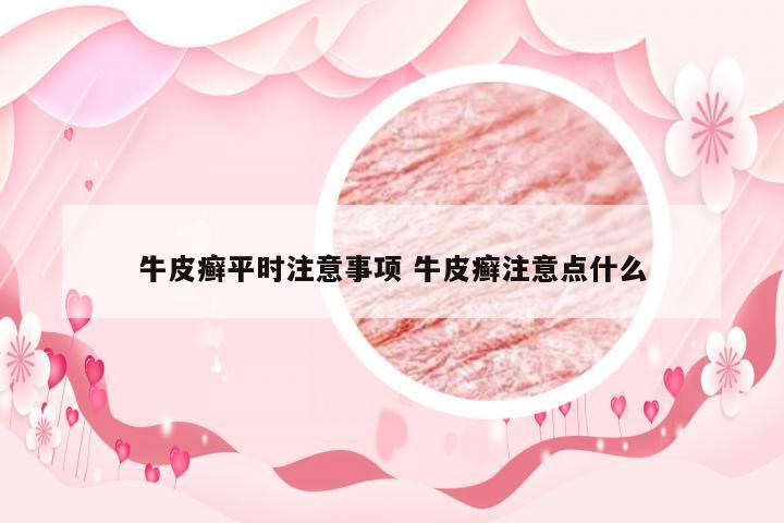牛皮癣平时注意事项 牛皮癣注意点什么