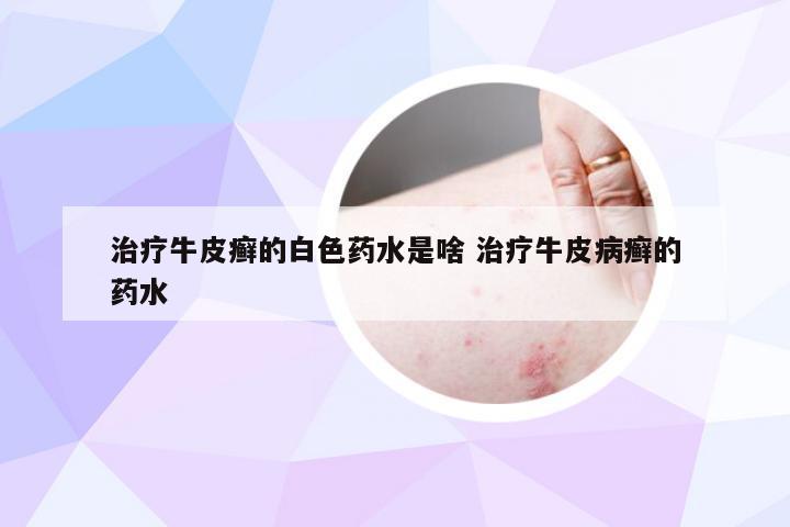 治疗牛皮癣的白色药水是啥 治疗牛皮病癣的药水