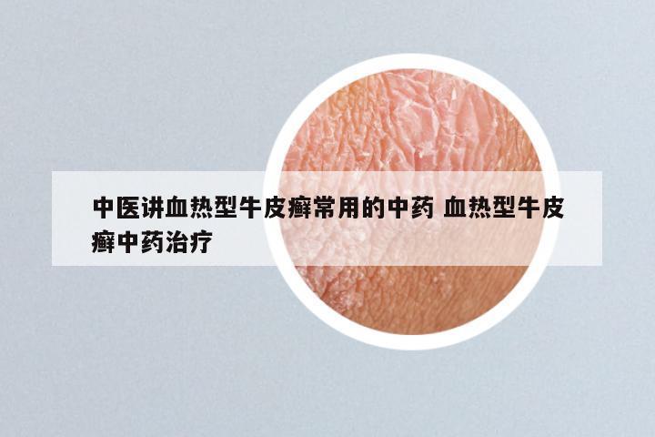 中医讲血热型牛皮癣常用的中药 血热型牛皮癣中药治疗