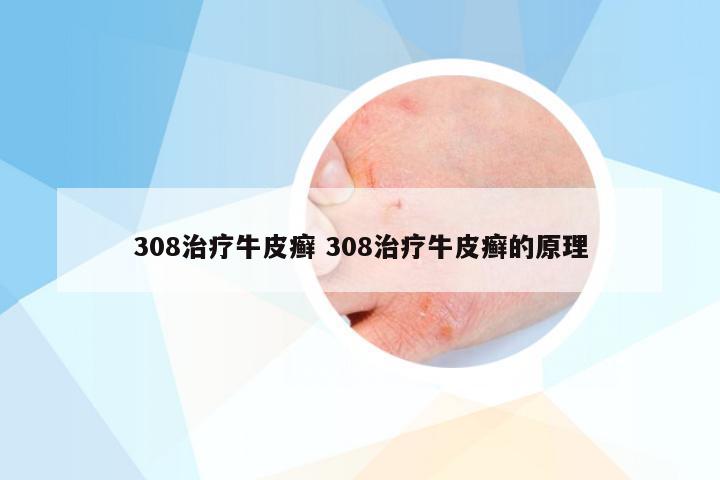 308治疗牛皮癣 308治疗牛皮癣的原理