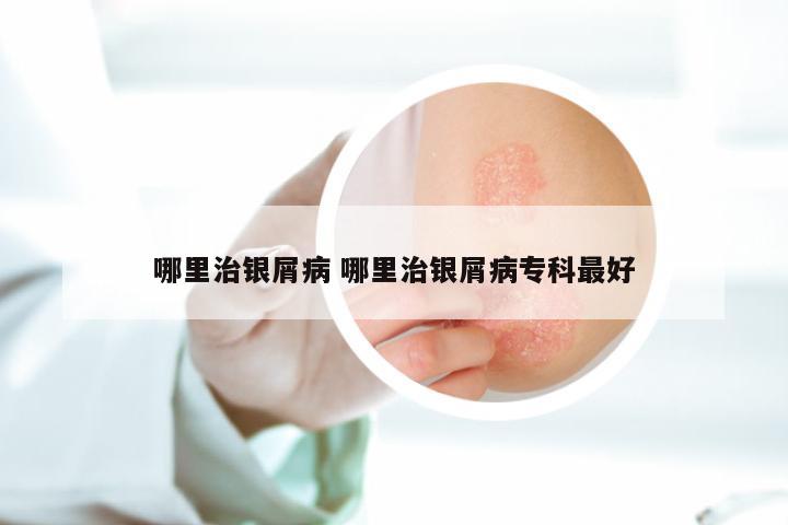 哪里治银屑病 哪里治银屑病专科最好