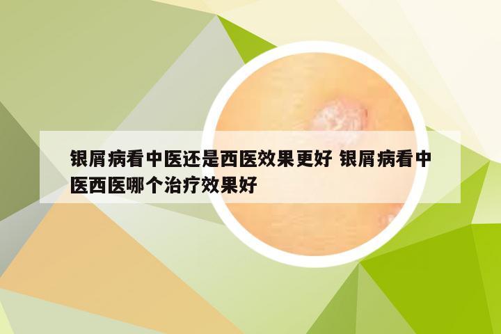 银屑病看中医还是西医效果更好 银屑病看中医西医哪个治疗效果好