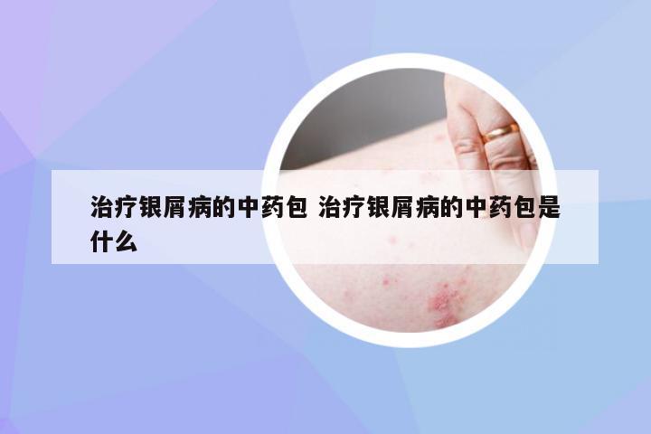 治疗银屑病的中药包 治疗银屑病的中药包是什么