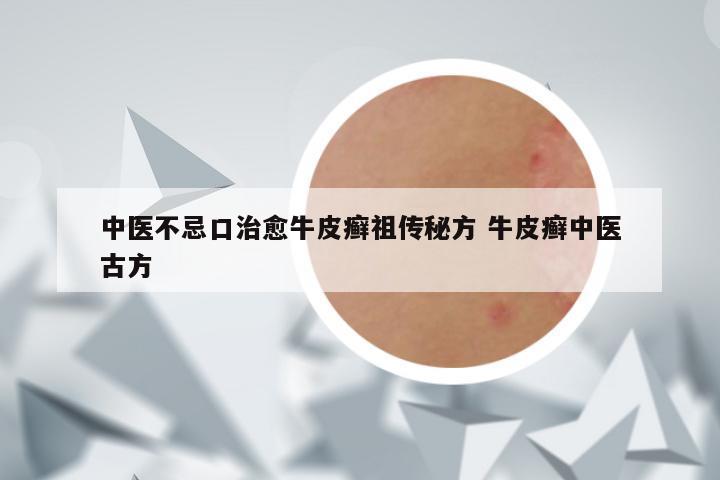 中医不忌口治愈牛皮癣祖传秘方 牛皮癣中医古方
