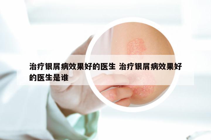 治疗银屑病效果好的医生 治疗银屑病效果好的医生是谁