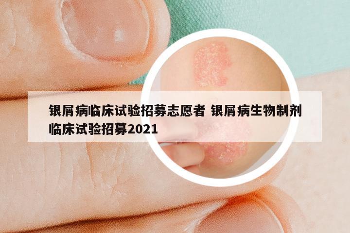 银屑病临床试验招募志愿者 银屑病生物制剂临床试验招募2021