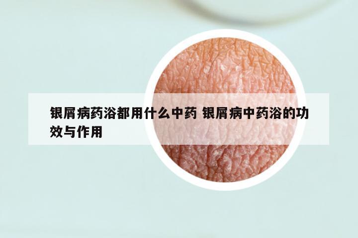银屑病药浴都用什么中药 银屑病中药浴的功效与作用