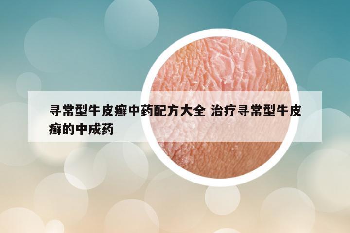寻常型牛皮癣中药配方大全 治疗寻常型牛皮癣的中成药