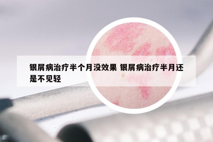 银屑病治疗半个月没效果 银屑病治疗半月还是不见轻