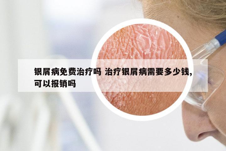 银屑病免费治疗吗 治疗银屑病需要多少钱,可以报销吗