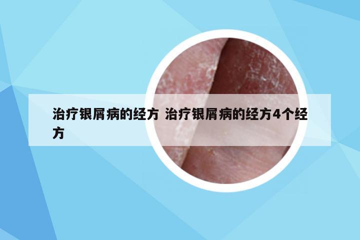 治疗银屑病的经方 治疗银屑病的经方4个经方