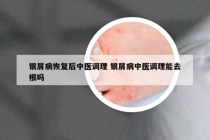 银屑病恢复后中医调理 银屑病中医调理能去根吗