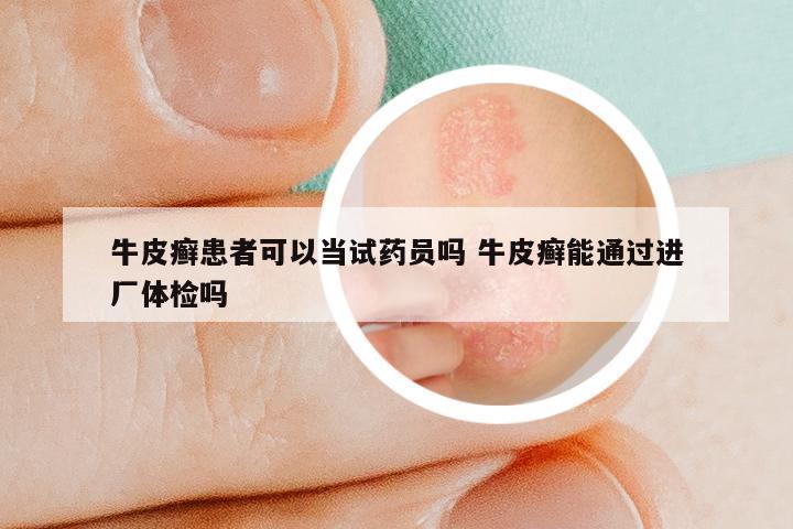 牛皮癣患者可以当试药员吗 牛皮癣能通过进厂体检吗