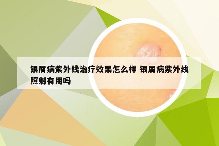 银屑病紫外线治疗效果怎么样 银屑病紫外线照射有用吗