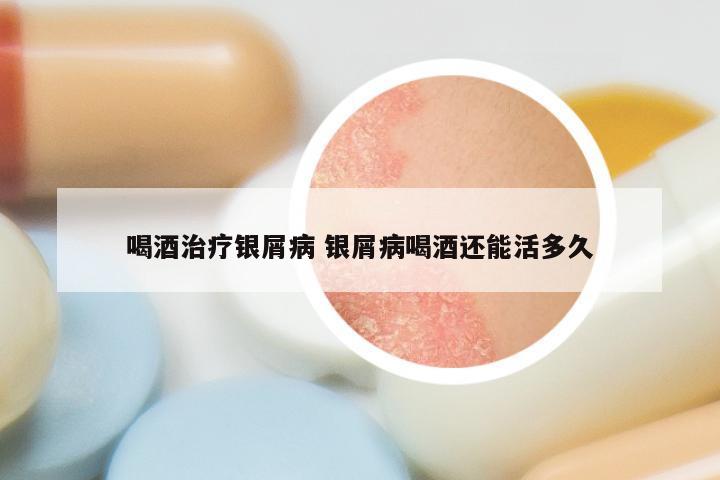 喝酒治疗银屑病 银屑病喝酒还能活多久