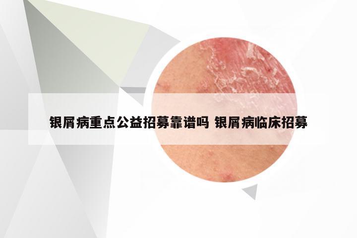 银屑病重点公益招募靠谱吗 银屑病临床招募