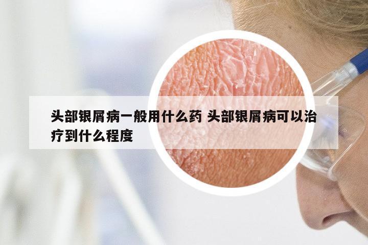 头部银屑病一般用什么药 头部银屑病可以治疗到什么程度