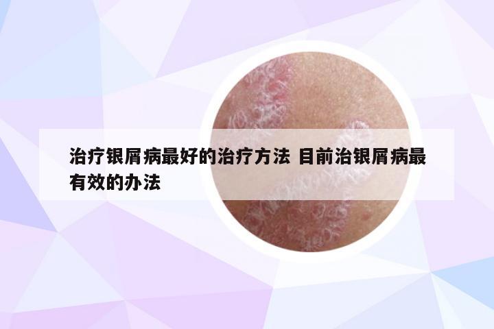 治疗银屑病最好的治疗方法 目前治银屑病最有效的办法