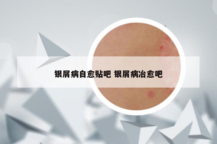 银屑病自愈贴吧 银屑病冶愈吧