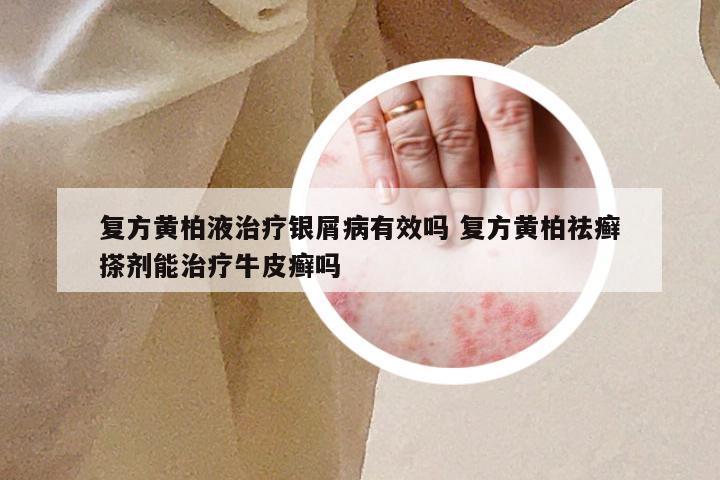 复方黄柏液治疗银屑病有效吗 复方黄柏祛癣搽剂能治疗牛皮癣吗
