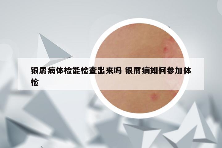 银屑病体检能检查出来吗 银屑病如何参加体检