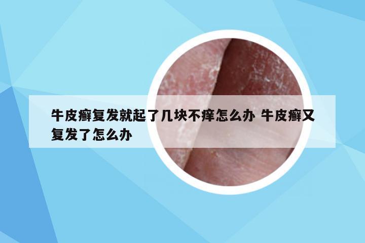 牛皮癣复发就起了几块不痒怎么办 牛皮癣又复发了怎么办