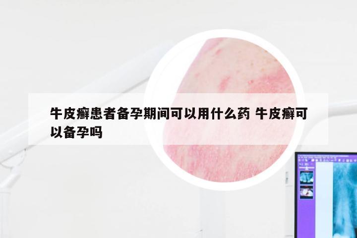 牛皮癣患者备孕期间可以用什么药 牛皮癣可以备孕吗