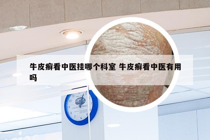 牛皮癣看中医挂哪个科室 牛皮癣看中医有用吗