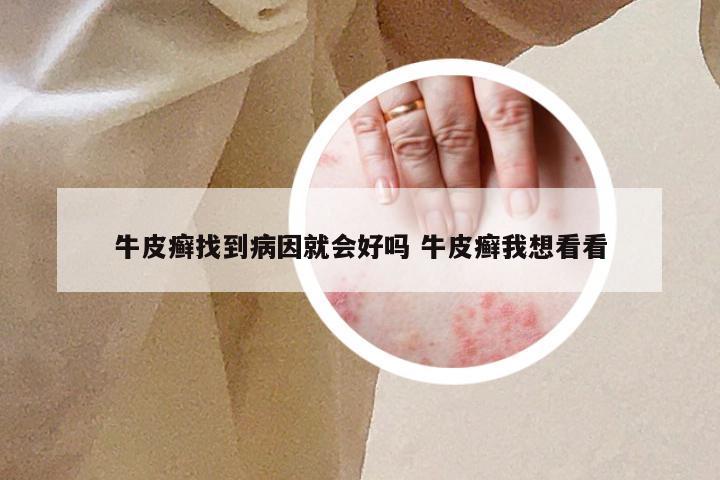 牛皮癣找到病因就会好吗 牛皮癣我想看看