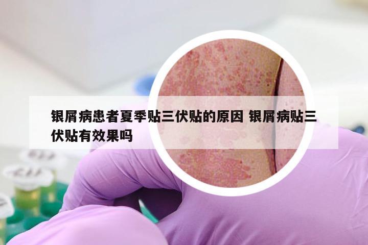 银屑病患者夏季贴三伏贴的原因 银屑病贴三伏贴有效果吗