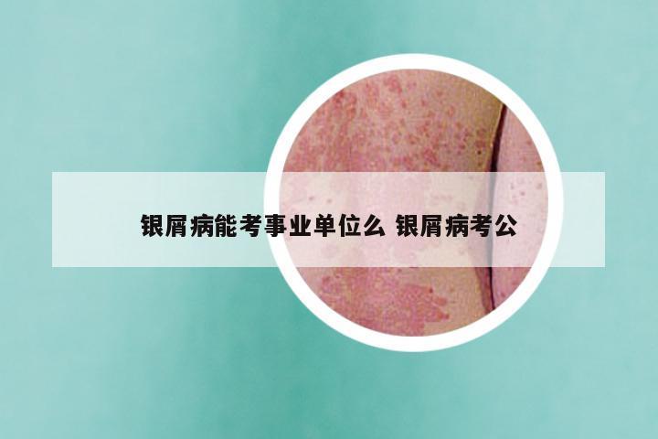 银屑病能考事业单位么 银屑病考公