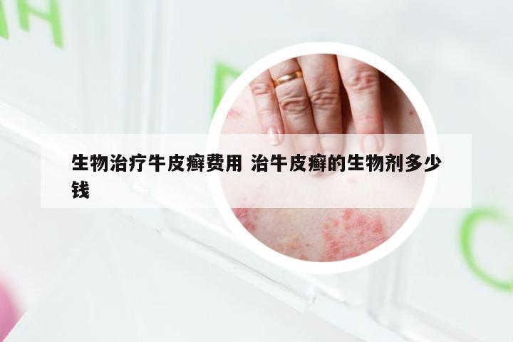 生物治疗牛皮癣费用 治牛皮癣的生物剂多少钱