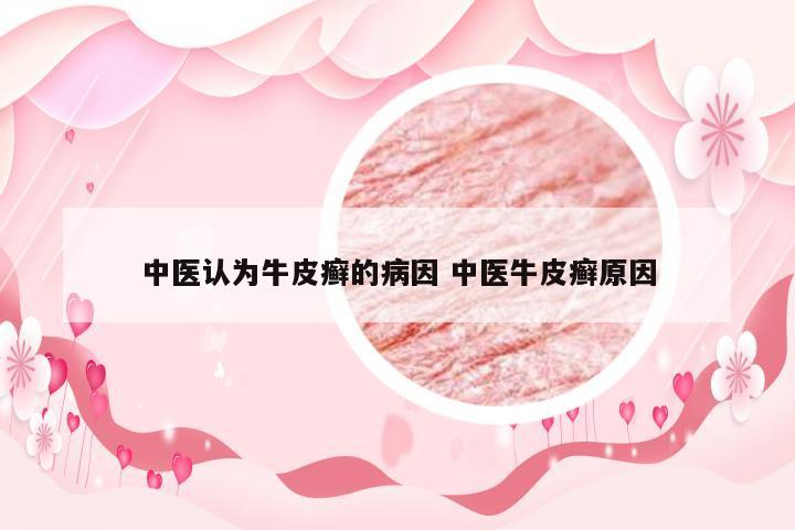 中医认为牛皮癣的病因 中医牛皮癣原因