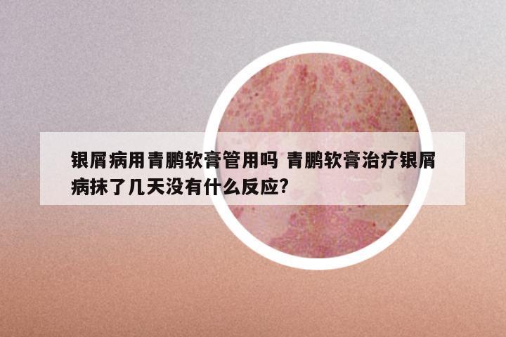 银屑病用青鹏软膏管用吗 青鹏软膏治疗银屑病抹了几天没有什么反应?