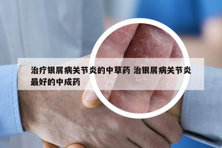 治疗银屑病关节炎的中草药 治银屑病关节炎最好的中成药