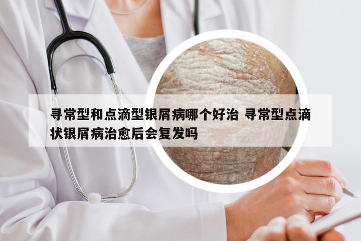 寻常型和点滴型银屑病哪个好治 寻常型点滴状银屑病治愈后会复发吗
