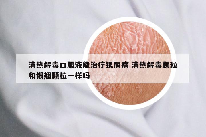 清热解毒口服液能治疗银屑病 清热解毒颗粒和银翘颗粒一样吗