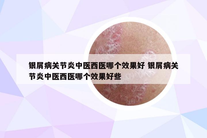 银屑病关节炎中医西医哪个效果好 银屑病关节炎中医西医哪个效果好些