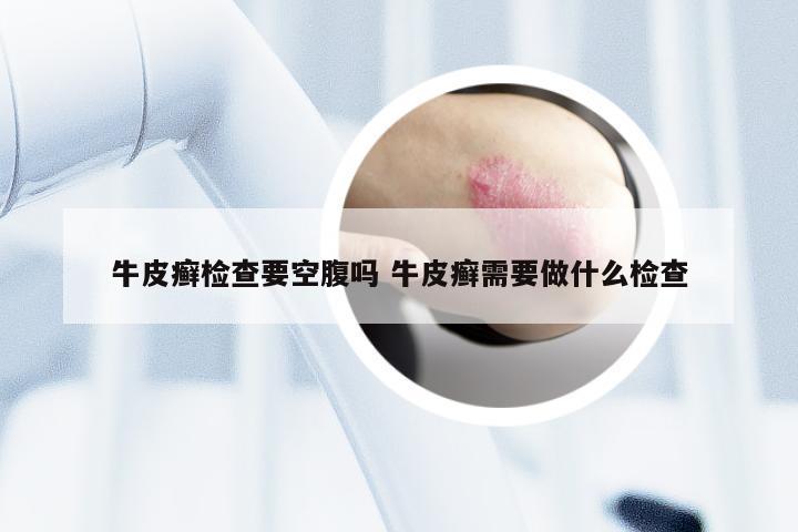 牛皮癣检查要空腹吗 牛皮癣需要做什么检查
