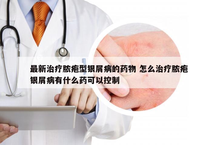 最新治疗脓疱型银屑病的药物 怎么治疗脓疱银屑病有什么药可以控制