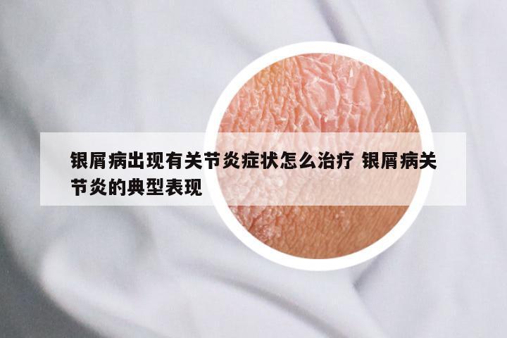 银屑病出现有关节炎症状怎么治疗 银屑病关节炎的典型表现