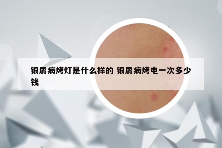 银屑病烤灯是什么样的 银屑病烤电一次多少钱