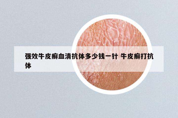 强效牛皮癣血清抗体多少钱一针 牛皮癣打抗体