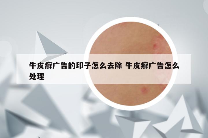 牛皮癣广告的印子怎么去除 牛皮癣广告怎么处理