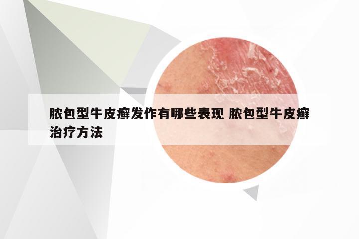脓包型牛皮癣发作有哪些表现 脓包型牛皮癣治疗方法