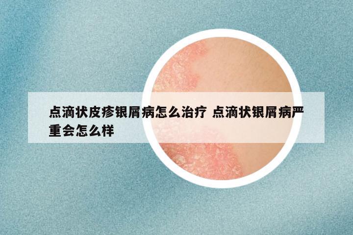 点滴状皮疹银屑病怎么治疗 点滴状银屑病严重会怎么样